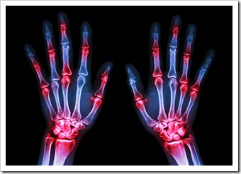 Rheumatoid Arthritis Solutions New Fairfield CT
