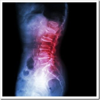 Back Pain New Fairfield CT Arthritis