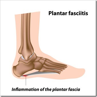 Foot Pain New Fairfield CT Plantar Fasciitis